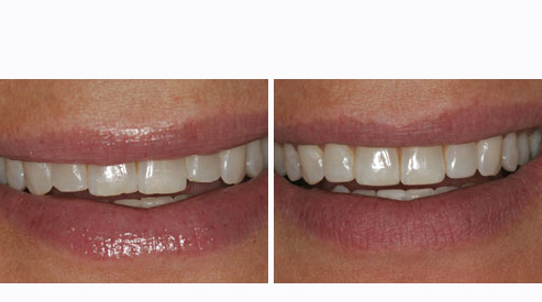 Teeth Modification Xpert Dental | Cedarhurst Dentist | Alan Rosen DDS